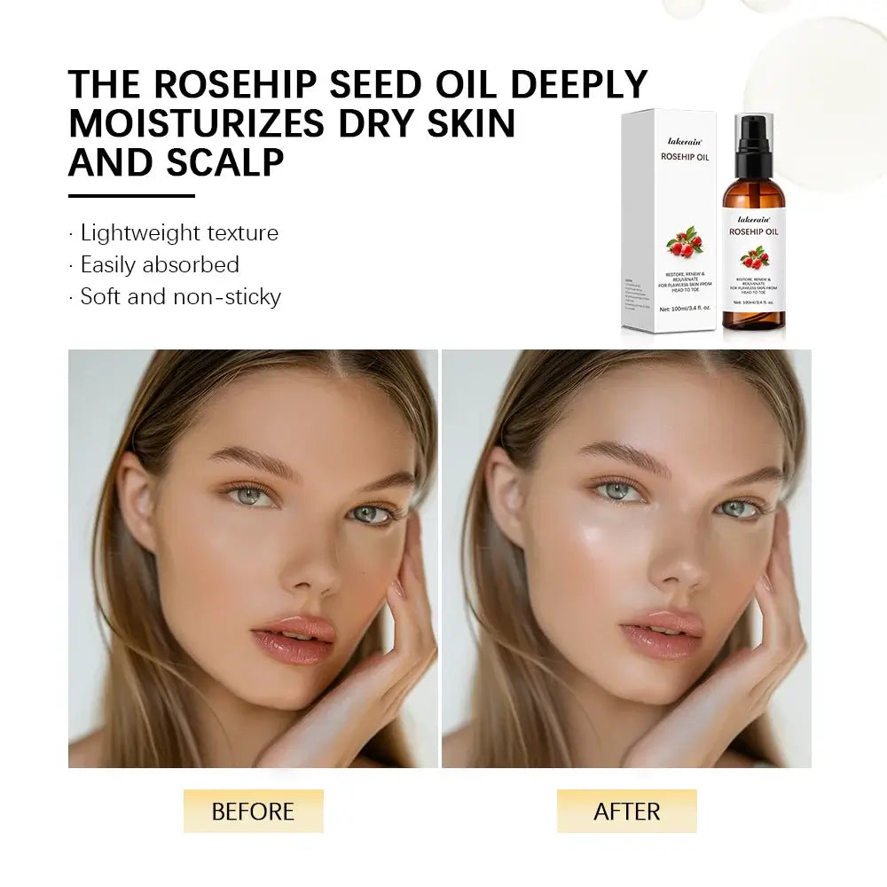 Organic Rosehip Oil Rose Hips Face Oils -Skin Care Moisturizer